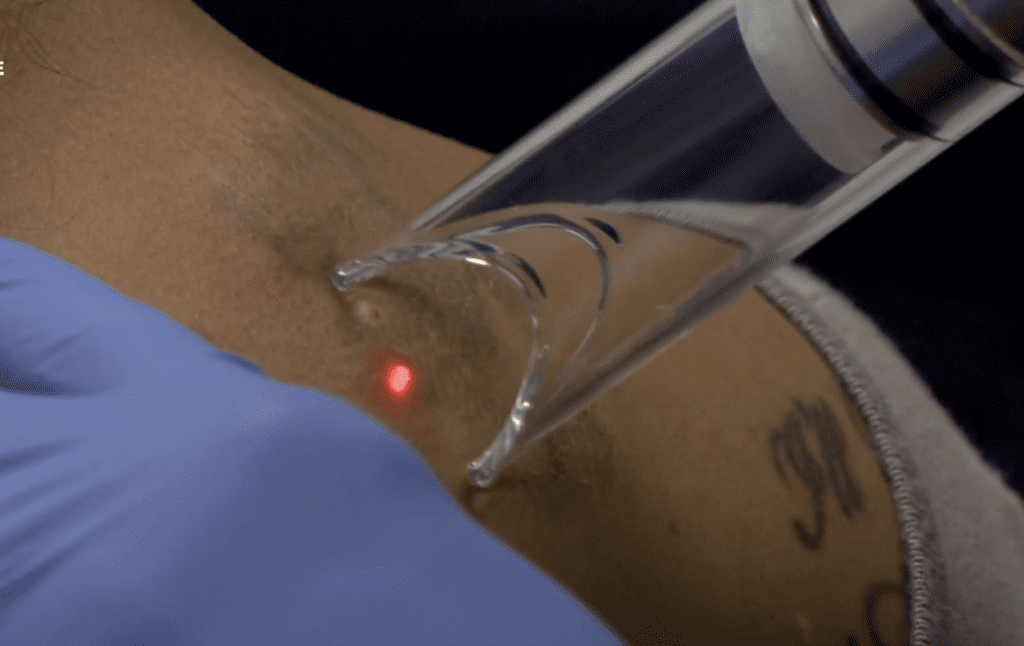 Free Tattoo Removal provided by Neighborhood Healthcare